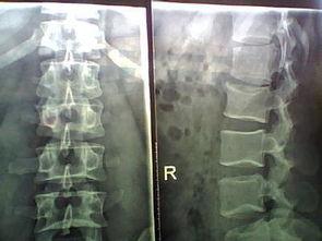 腰椎骨质增生怎么锻炼视频,专业指导,缓解疼痛,增强腰背力量