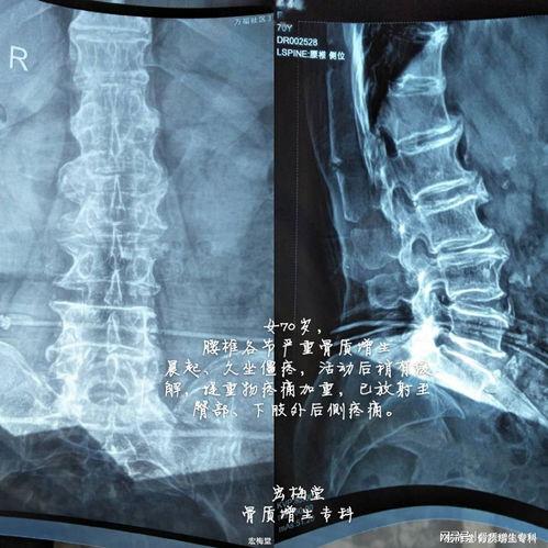 腰椎骨质增生怎么锻炼视频,专业指导,缓解疼痛,增强腰背力量